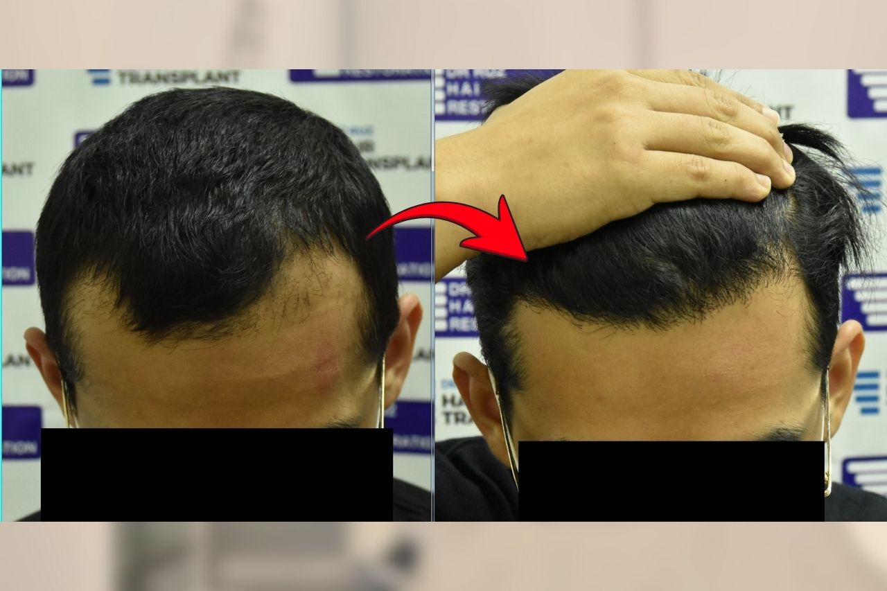 Before and after hair restoration results at InterClinic, showing natural hair regrowth and improved hair density.