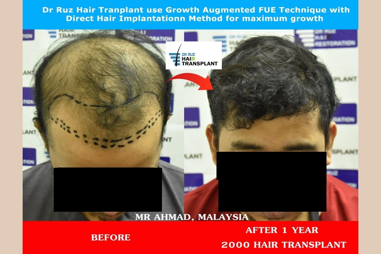 Before and after results of hair restoration treatment at leading hair restoration clinic in Malaysia